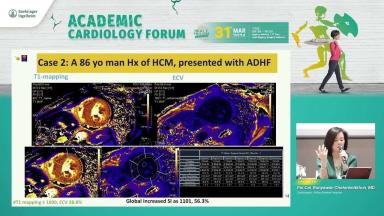 CMR in Restrictive Cardiomyopathy By Dr.Runyawan
