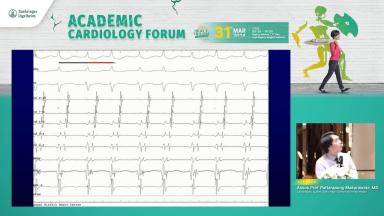 ECG from outsides to inside Intracardiac Electrogram for Cardiologist by Dr.Pattarapong